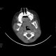 Eosinophilic granuloma of a bone: CT - Computed tomography
